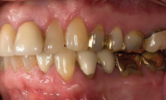Рис. 1. Клинический вид дефектного мостовидного протеза, зубы № 19–21