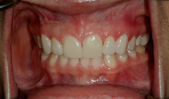 Рис. 12. Временные реставрации во рту пациентки, (снимок с губным ретрактором)