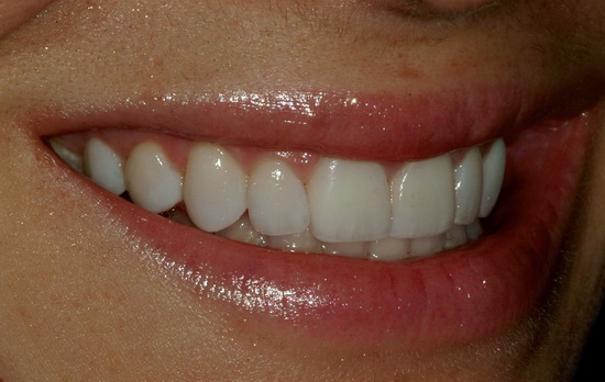Рис. 36. Вид справа улыбки пациентки после завершения лечения