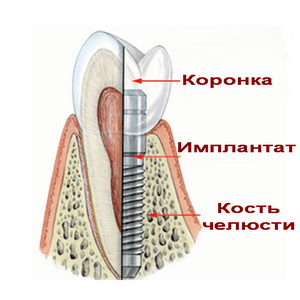 стоматологические инструмент
		<!--