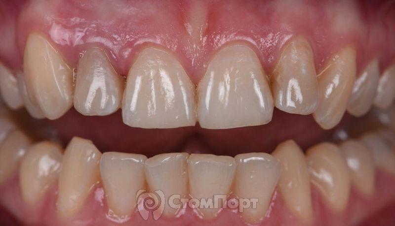 Реставрация зуба с использованием красок-18