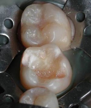 Препарирование, медикаментозная обработка 36 зуба