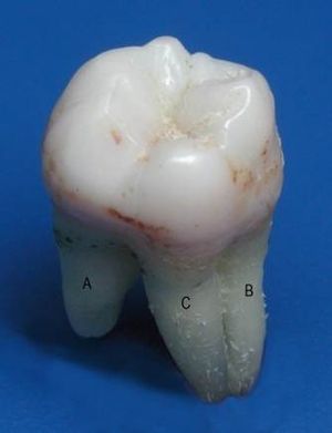 26 зуб, жевательная, вестибулярная, задняя контактная поверхности