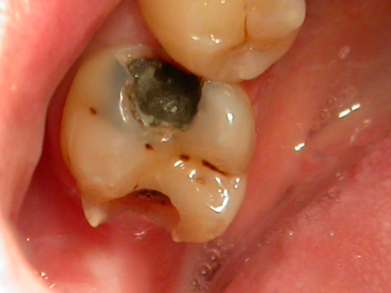 Ошибки лечения канала зуба