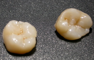 Лечение при разрушении зуба thumbnail