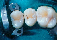 Метод лечения разрушенных зубов