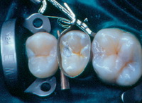 Лечение при разрушении тканей зуба