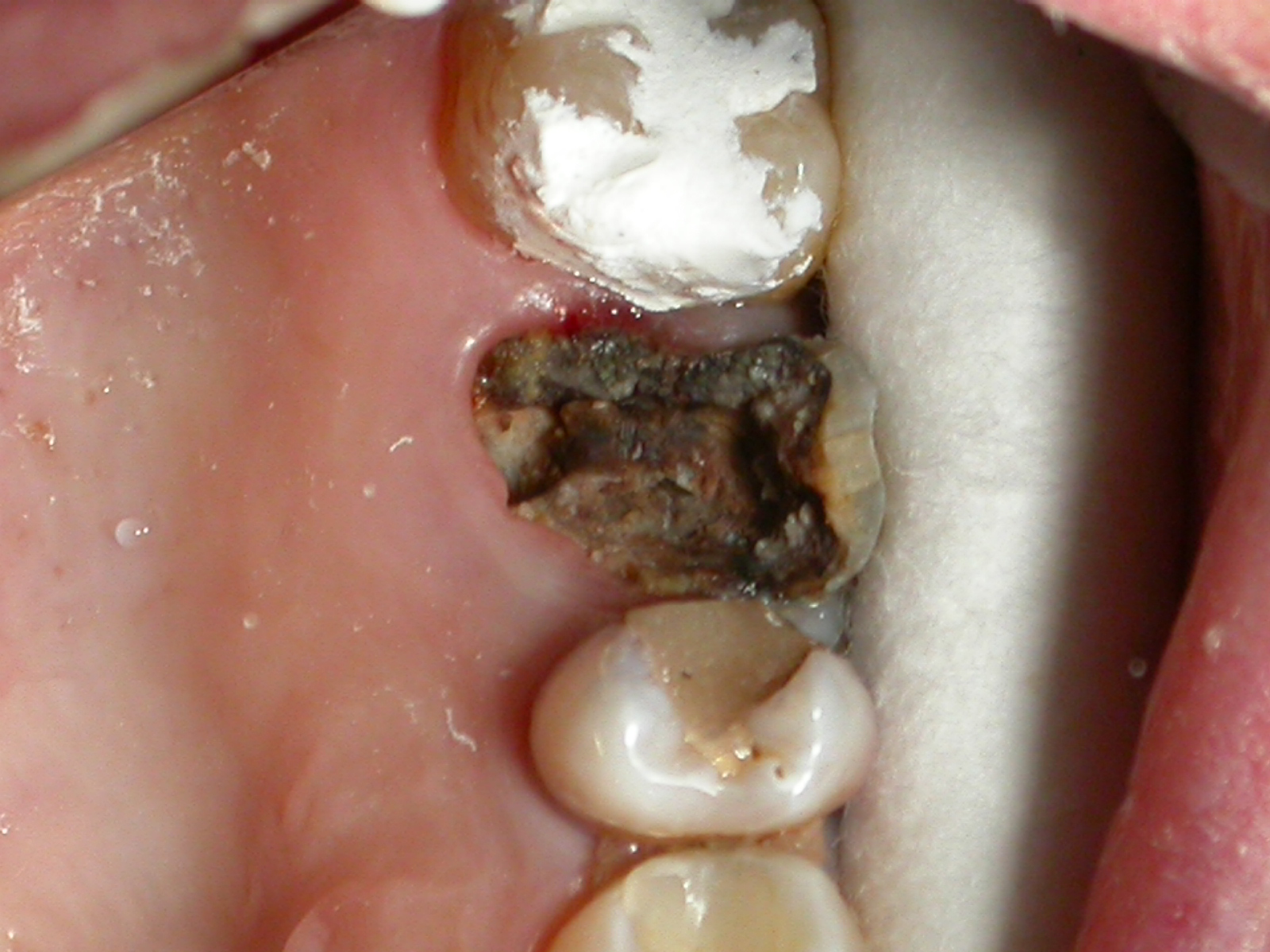Ошибки и осложнение при лечение зубов thumbnail