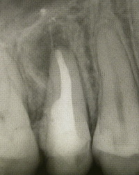 Лечение околокорневая киста зуба