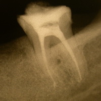 Разрушение зуба после лечения thumbnail