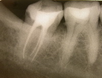 Метод лечения разрушенных зубов
