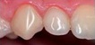 Пломбировочные материалы для лечения зубов