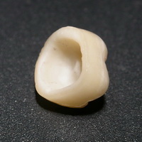 Стоматология лечение разрушенных зубов thumbnail
