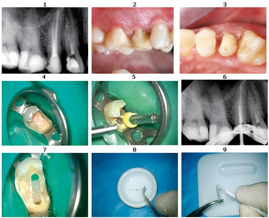Восстановление формы зуба после эндодонтического лечения