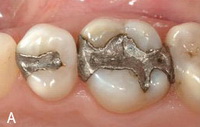 Пломбировочные материалы для лечения зубов