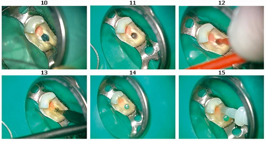 Методики восстановления зуба после эндодонтического лечения
