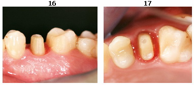 Методы реставрации зубов после эндодонтического лечения