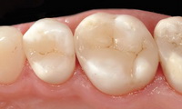 Этапы лечения зуба пломба