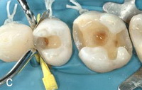 Этапы лечения зуба пломба