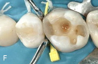 Пломбирование одной поверхности зуба при лечении thumbnail