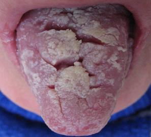 Красный плоский лишай в полости рта дифференциальная диагностика
