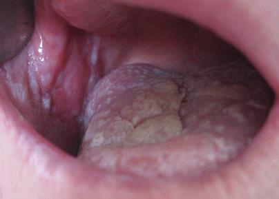 Красный плоский лишай в полости рта дифференциальная диагностика