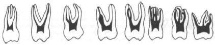 Лечение корневых каналов зуба правильный доступ
