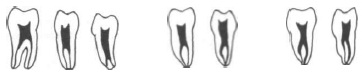 Нижние коренные зубы лечение