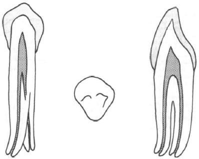 Нижние коренные зубы лечение