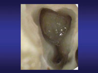 Эндодонтическое лечение корневых каналов зубов мастер класс