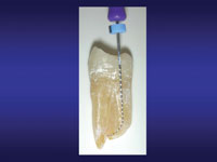 Эндодонтическое лечение корневых каналов зубов мастер класс видео