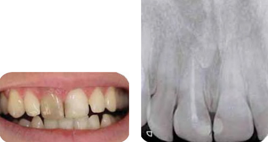 Изменение цвета зуба из за эндодонтического лечения thumbnail