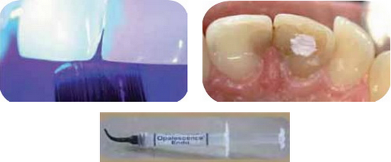 Изменение цвета зуба из за эндодонтического лечения