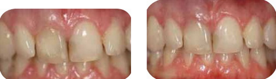Изменение цвета зуба из за эндодонтического лечения