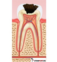 Этапы лечения зуба пломба