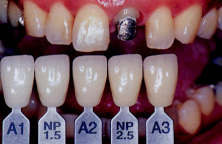 А3 цвет зубов фото у женщин