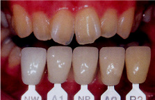 Цвет зубов а2 цирконий фото
