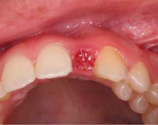 Рис. 2а. Клинический вид после удаления зуба