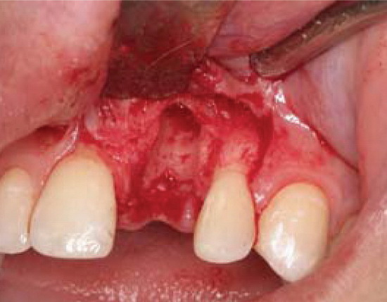 Рис. 6. Удаление зуба и хирургическая обработка раны