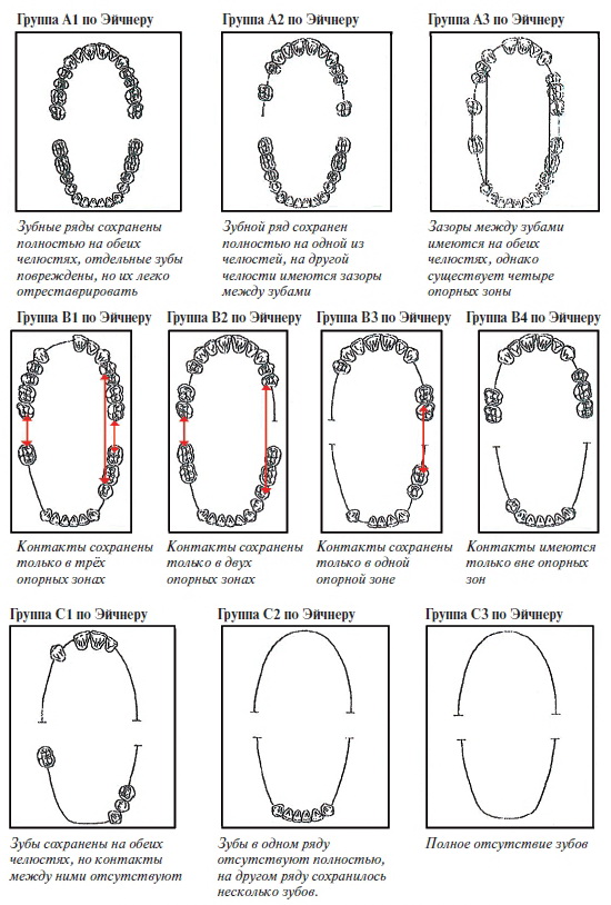 Рис. 2. Классификация остаточного зубного ряда по Эйчнеру