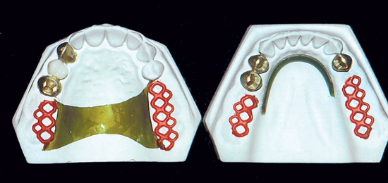 Рис. 7. Укороченные зубные ряды с обеих сторон верхней и нижней челюсти.