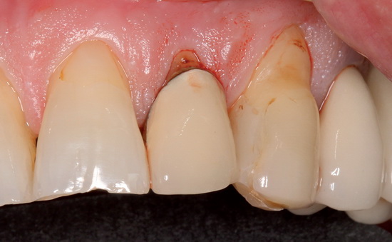 Рис. 1. Исходная ситуация в области зубов 22 и 23: вид со стороны щечной поверхности