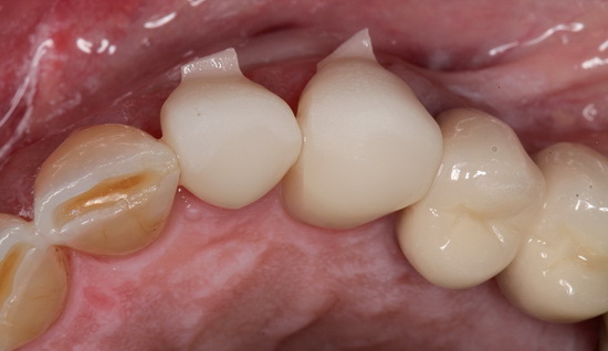 Рис. 12. Примерка коронок для зубов 22 und 23: вид со стороны поверхности окклюзии