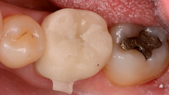 Рис. 13. Примерка коронки для зуба 46