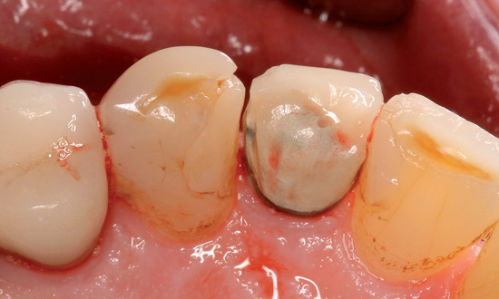 Рис. 2. Исходная ситуация в области зубов 22 и 23: вид со стороны небной поверхности