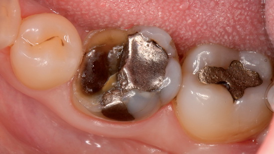 Рис. 3. Исходная ситуация в области зуба 46