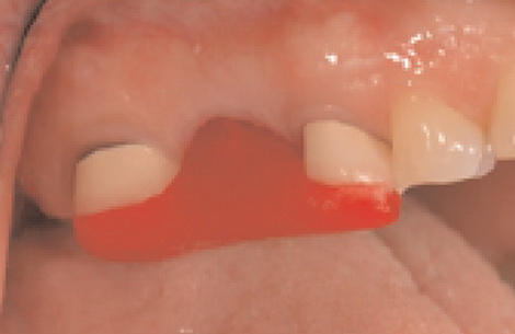 Рис. 9b. Абатмент, размещенный во рту с помощью полимерной упорной пластины