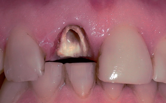Рис. 1. Фрагмент зубного ряда пациентки К., 39 лет. Диагноз: полный отлом коронковой части зуба 1.1