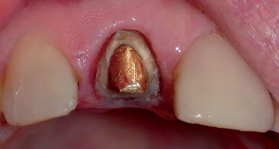 б) фиксированная в корневом канале зуба 1.1
