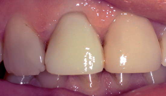 Рис. 5. Провизорная коронка (а) (Protemp® 4 Garant 3M ESPE) на зубе 1.1; 